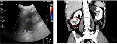 Primary renal sporadic hemangioblastoma: A case report and literature review
